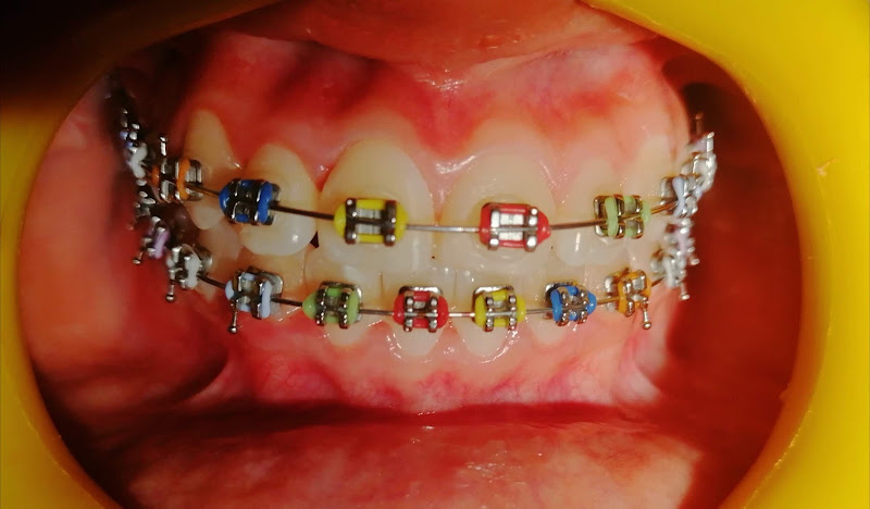 dentista barato Huejutla de Reyes